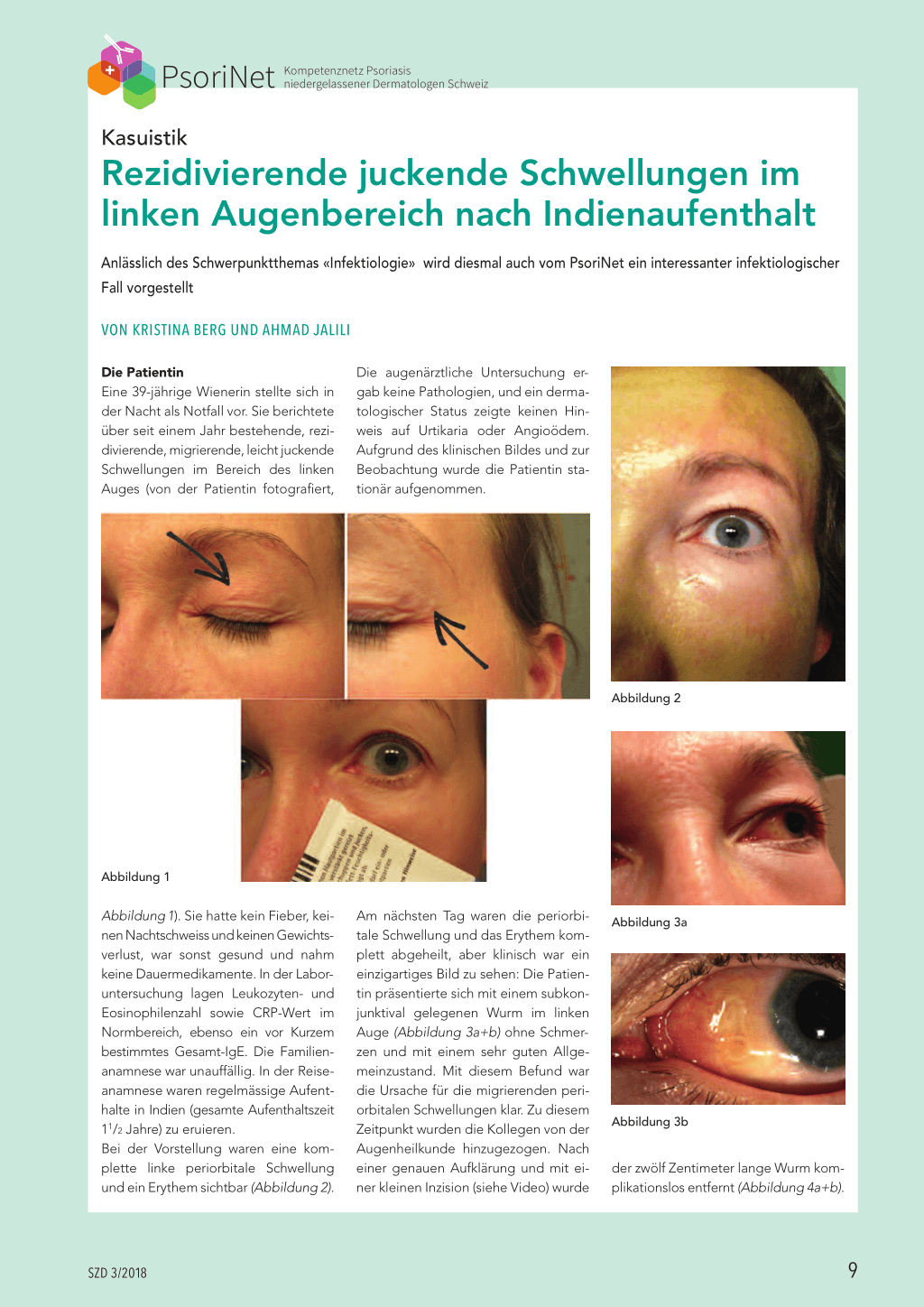 Rezidivierende juckende Schwellungen im linken Augenbereich nach ...