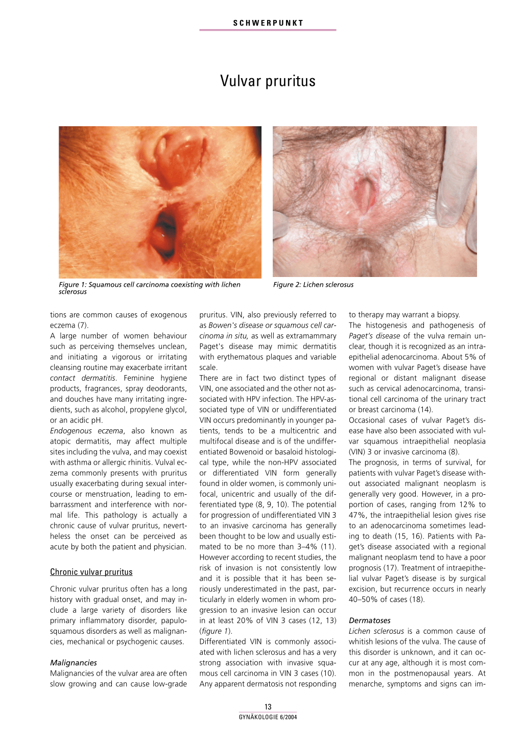 hpv impfung lichen sclerosus treatment of urinary bladder papilloma